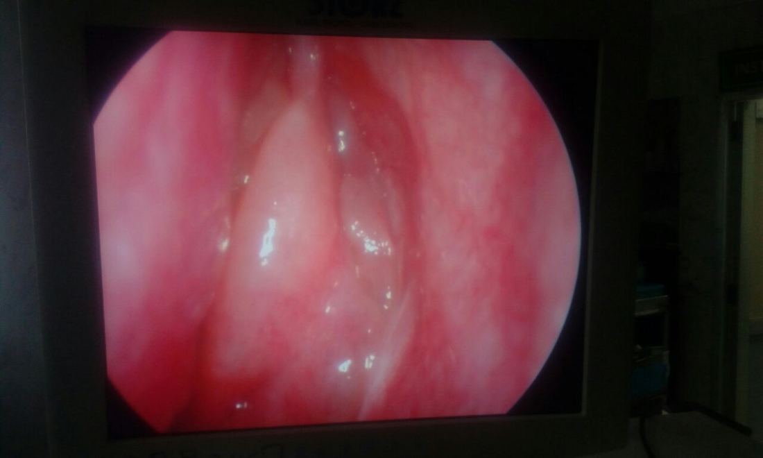 Endoscopy showing sinus fungus