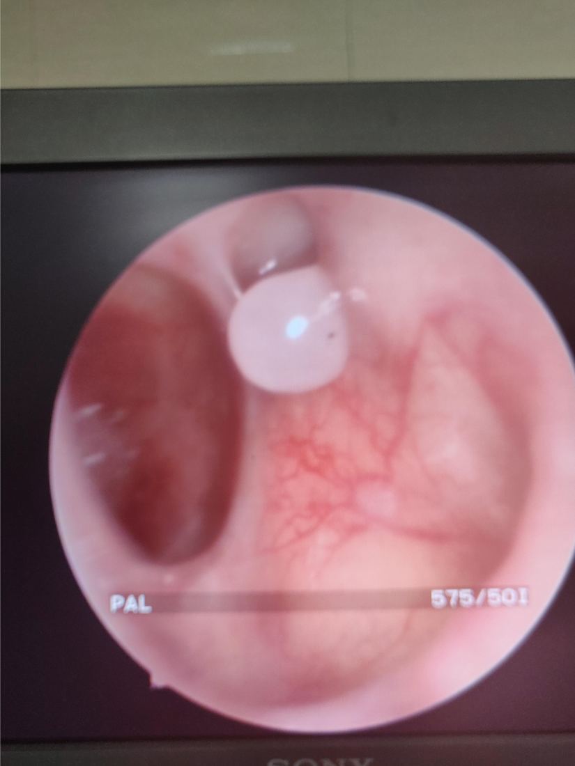 Endoscopy showing clear sinus cavities