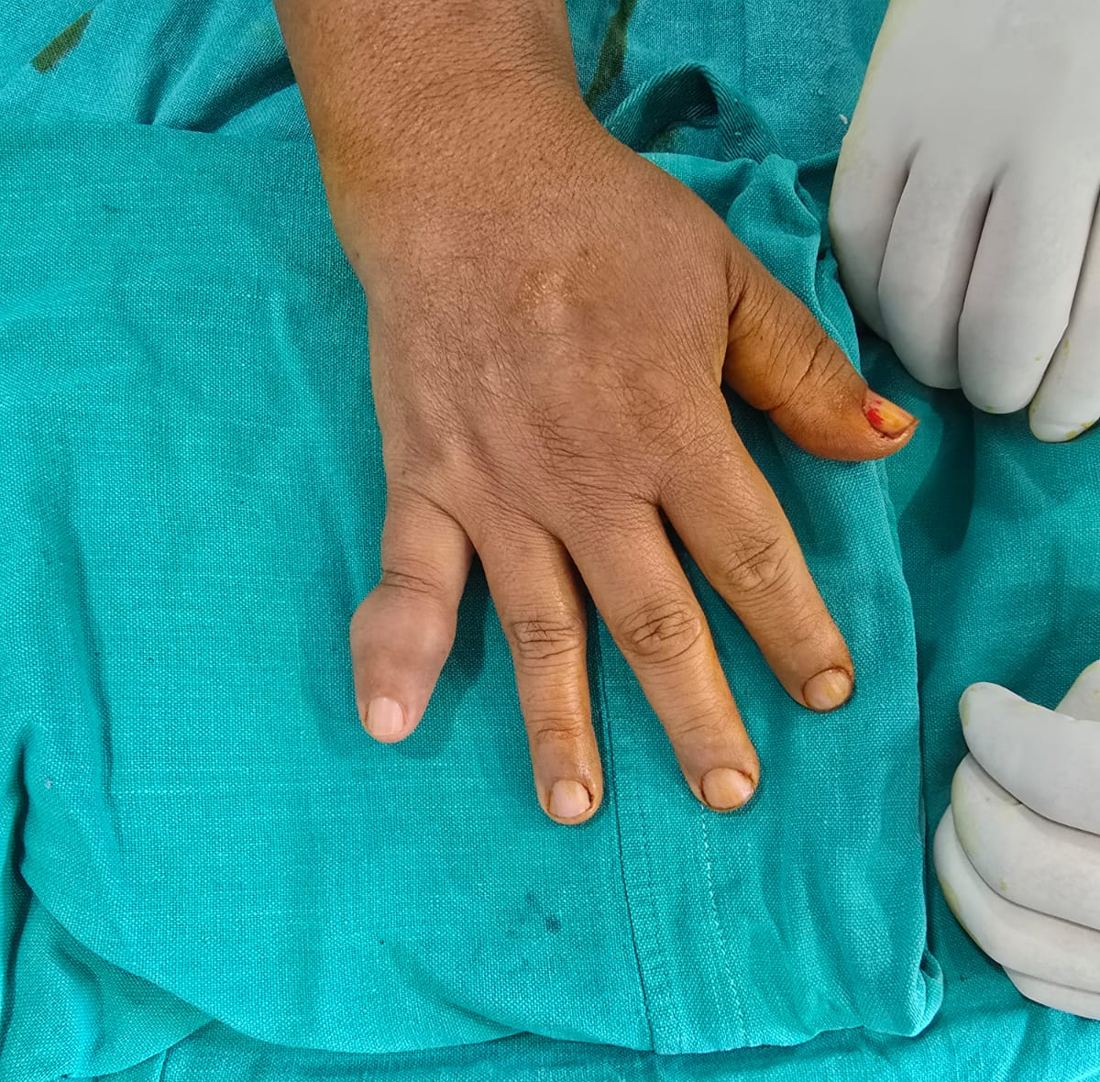 Finger swelling