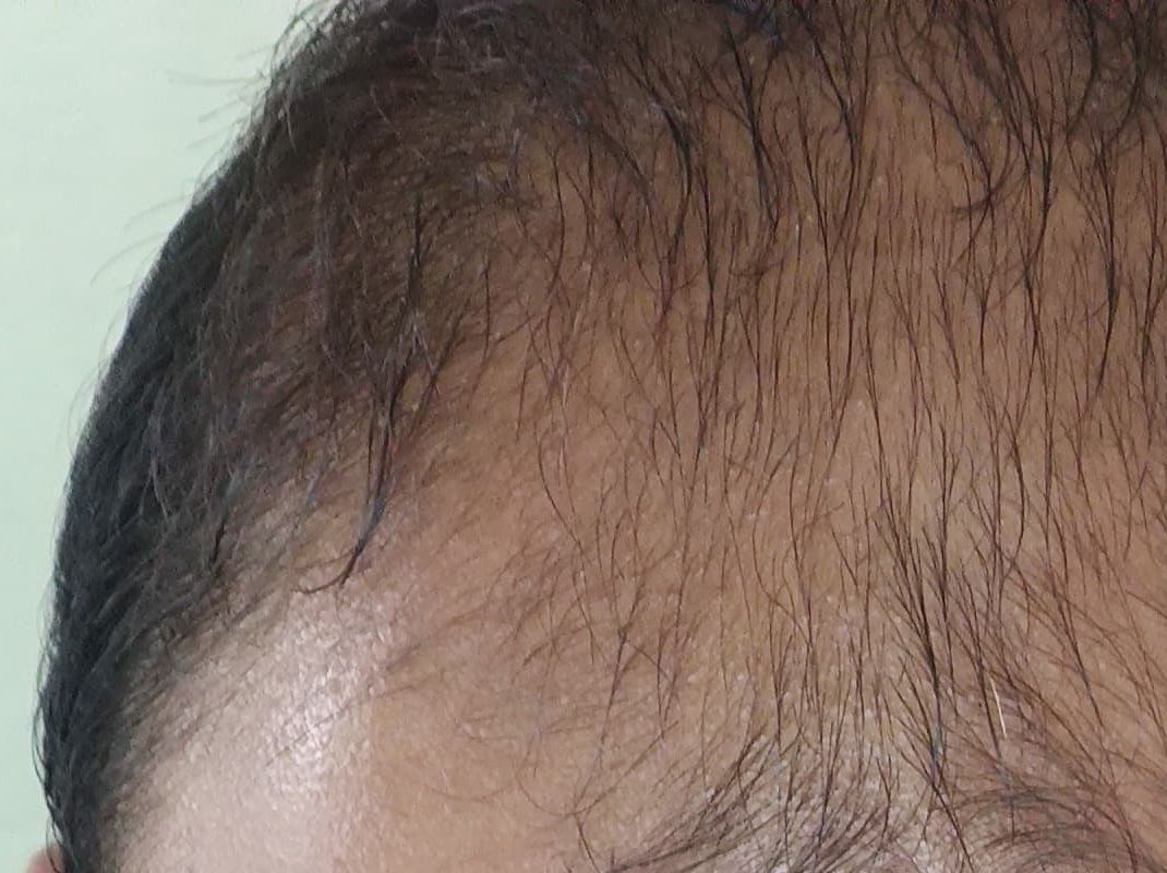 Hair after restoration