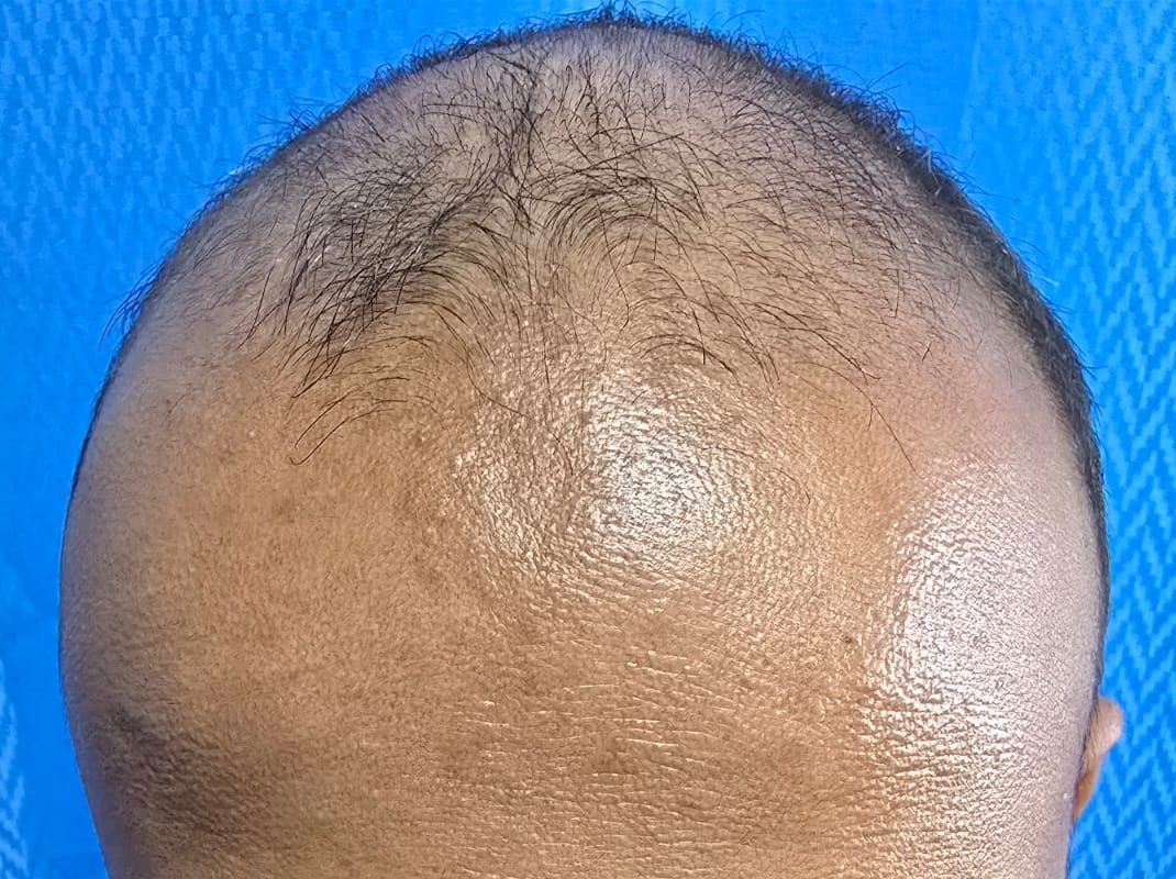 Hair before restoration