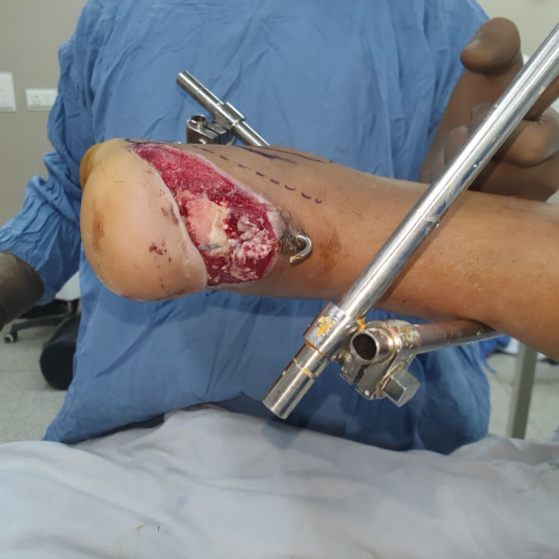 Heel flap surgery