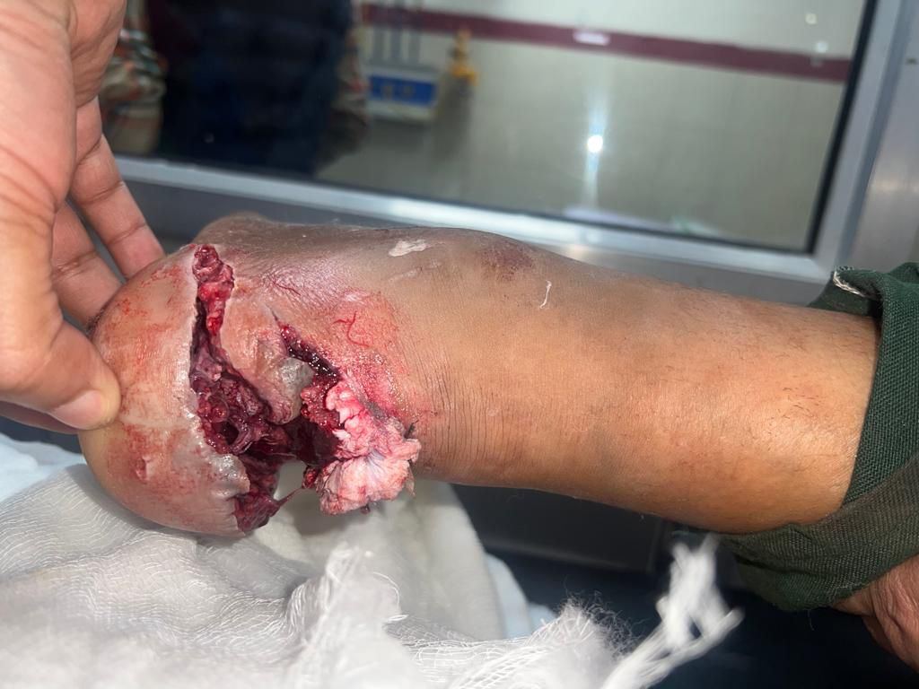 Heel wound