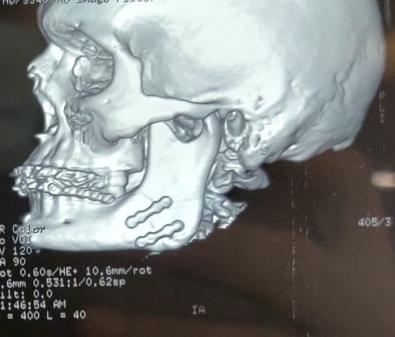Post-op 3D CT titanium plates