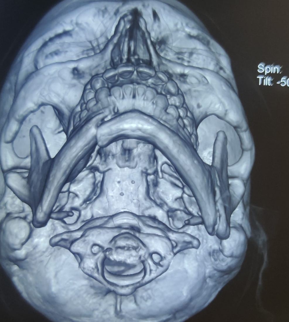 Pre-op 3D CT jaw fracture