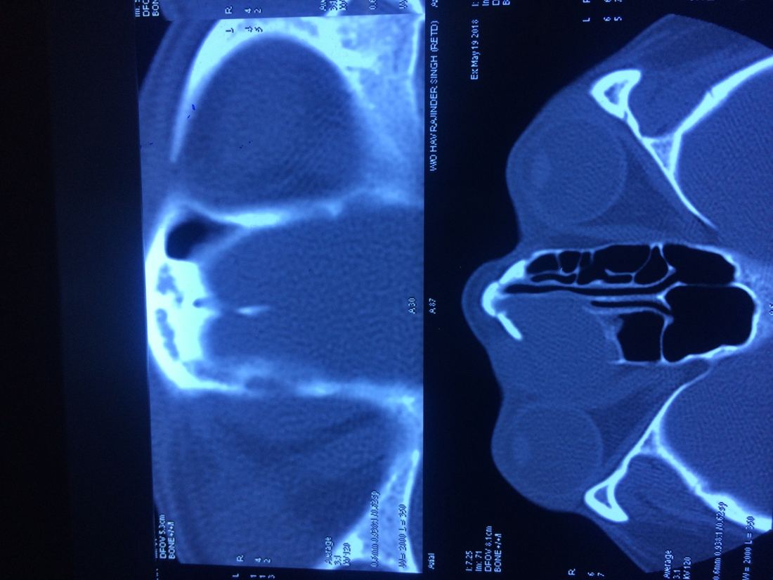 Sinus CT scan