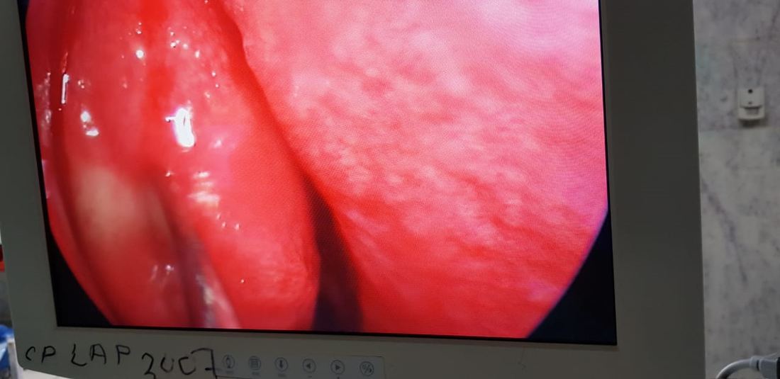 Endoscopic sinus view