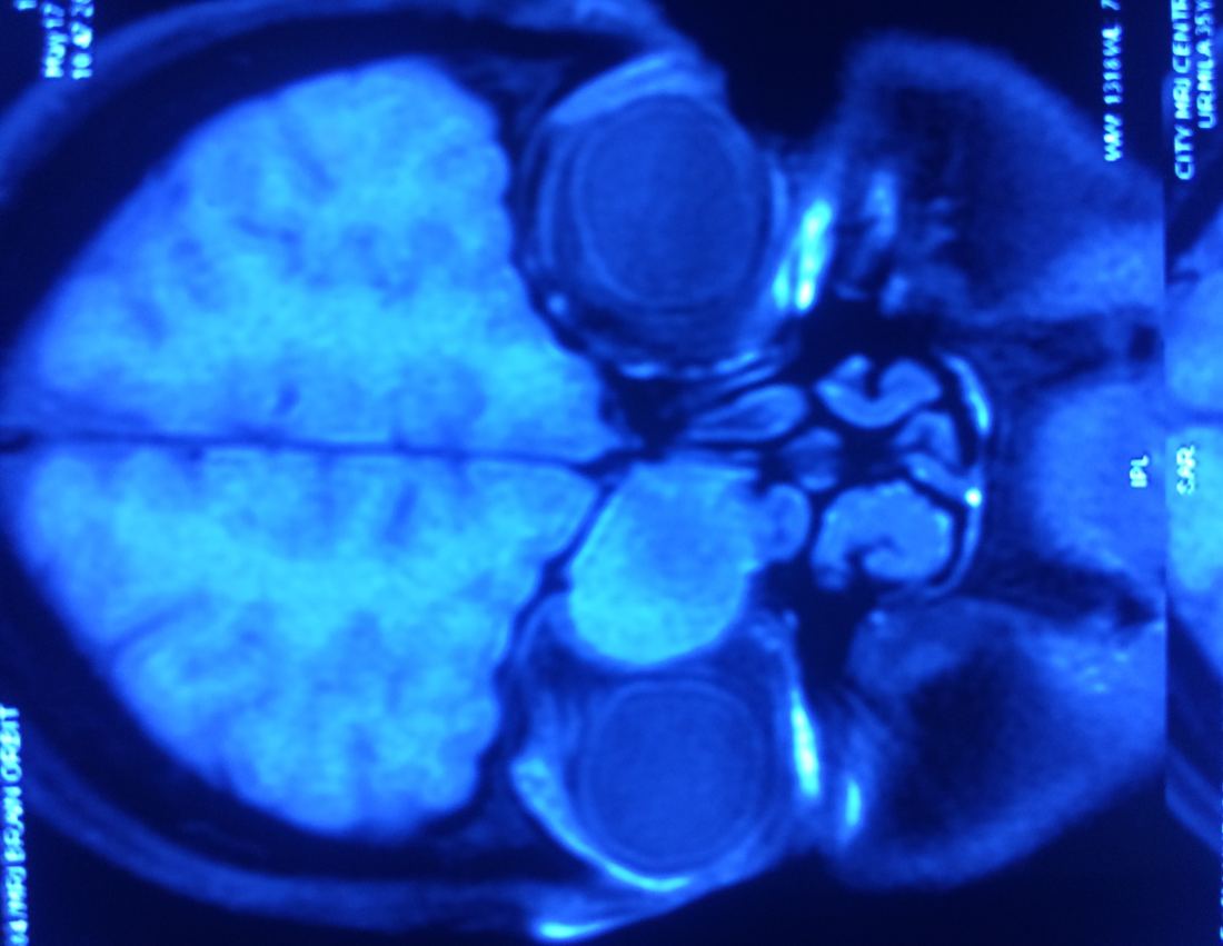 Orbit and nasal MRI