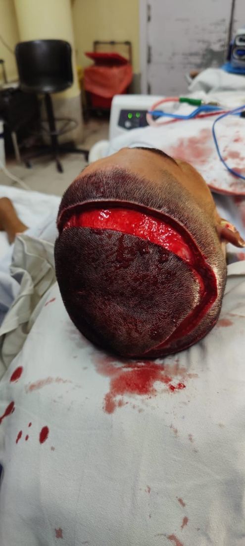 Scalp rotation flap