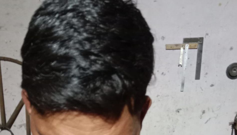 Healed scalp with normal hair growth