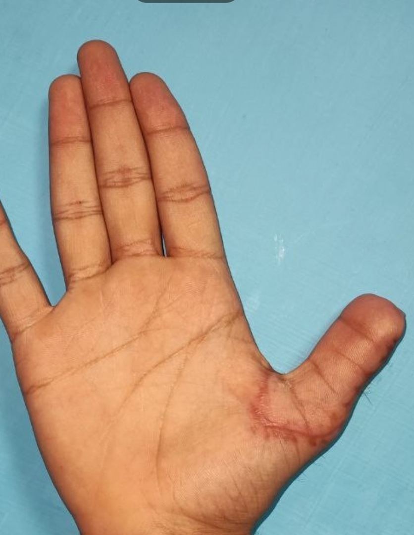 Healed thumb palm view