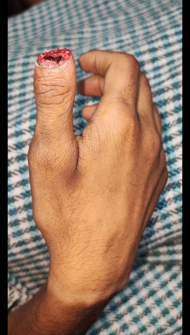 Thumb tip injury