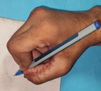 Writing with restored thumb