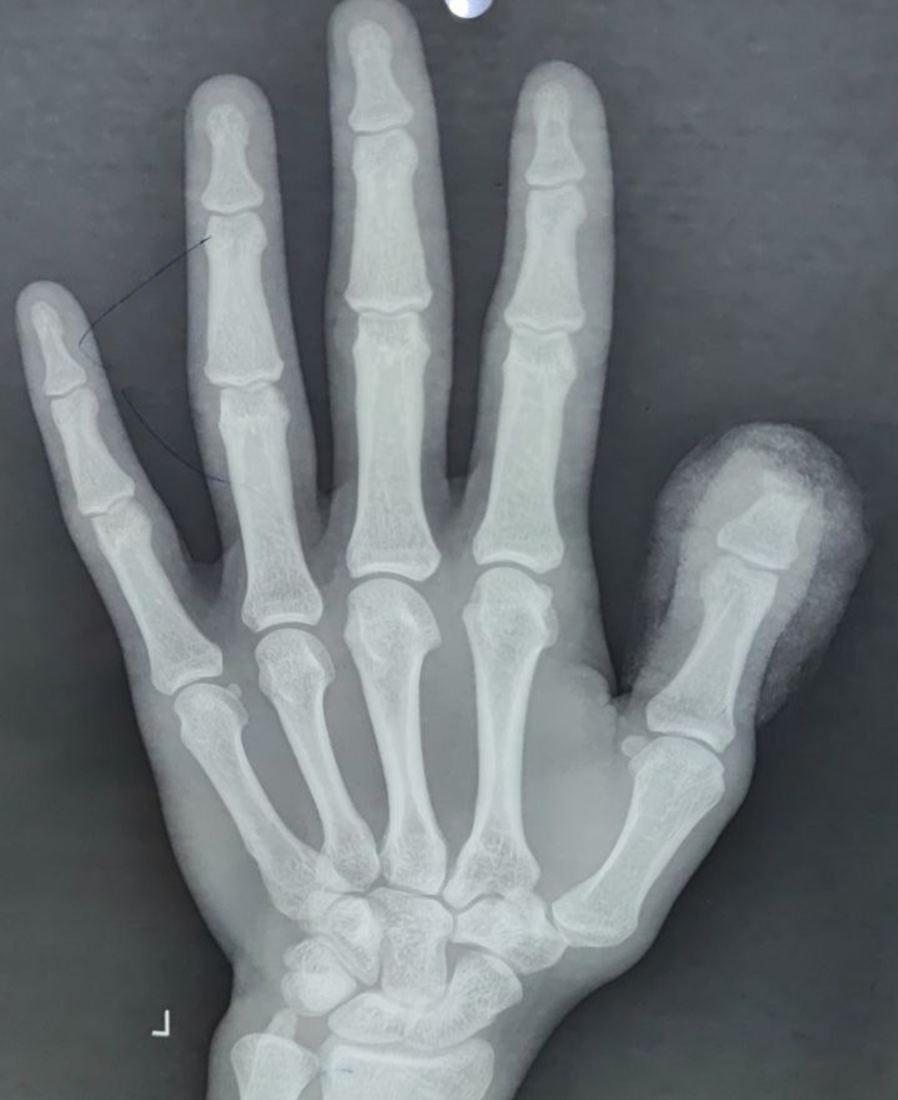 Thumb bone X-ray